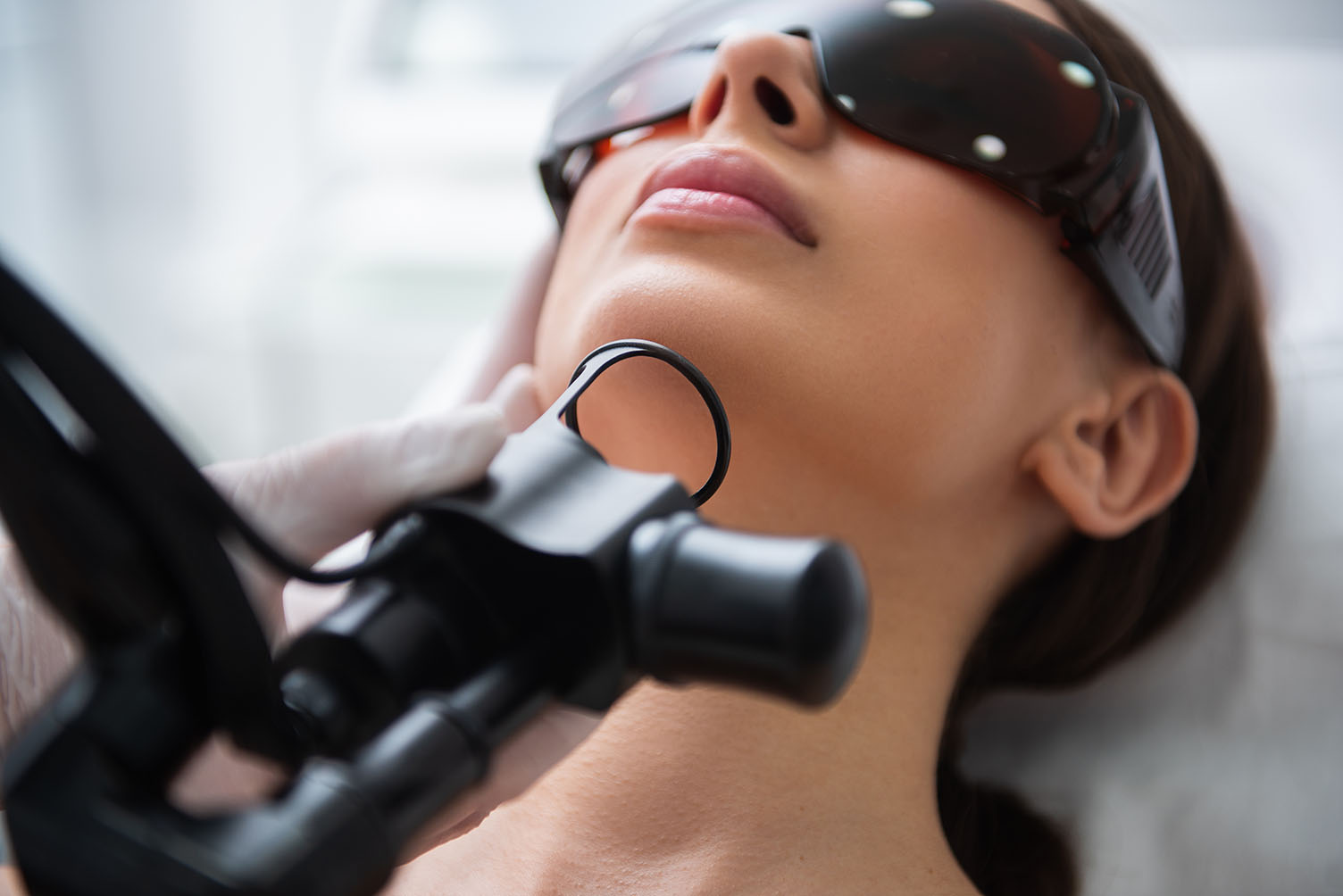 laser hair removal | under chin fractional laser